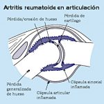 artritis