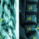 hernia-discal