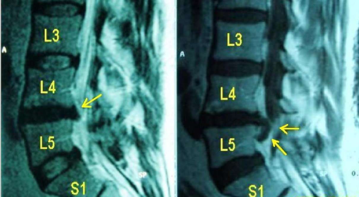 Qué es una hernia discal, causas, síntomas y diagnóstico