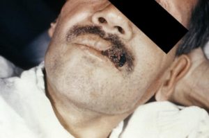 Hongos en la piel (micosis cutánea), causas, tratamiento y prevención