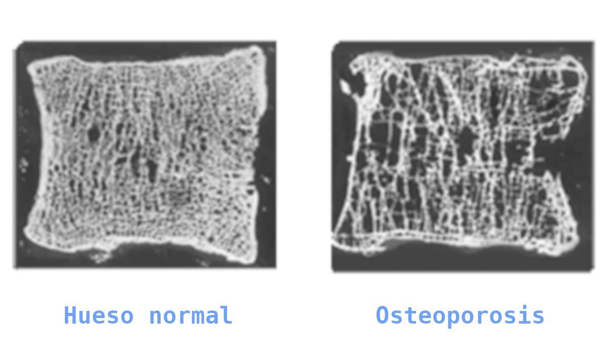 Osteoporosis, información, causas y órganos afectados