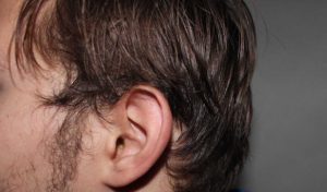 La otitis y sus causas asociadas, tipos, síntomas y prevención