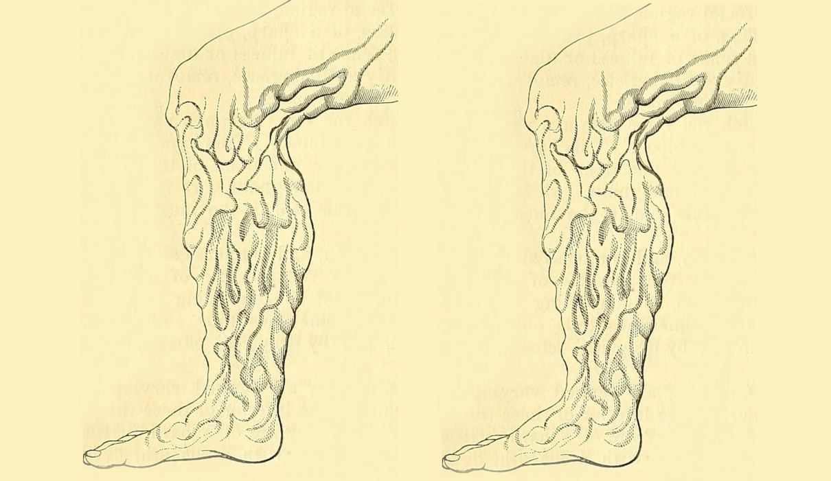 Varices