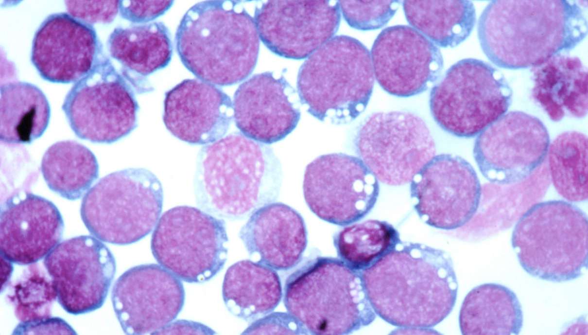 Enfermedad del beso (Mononucleosis infecciosa)